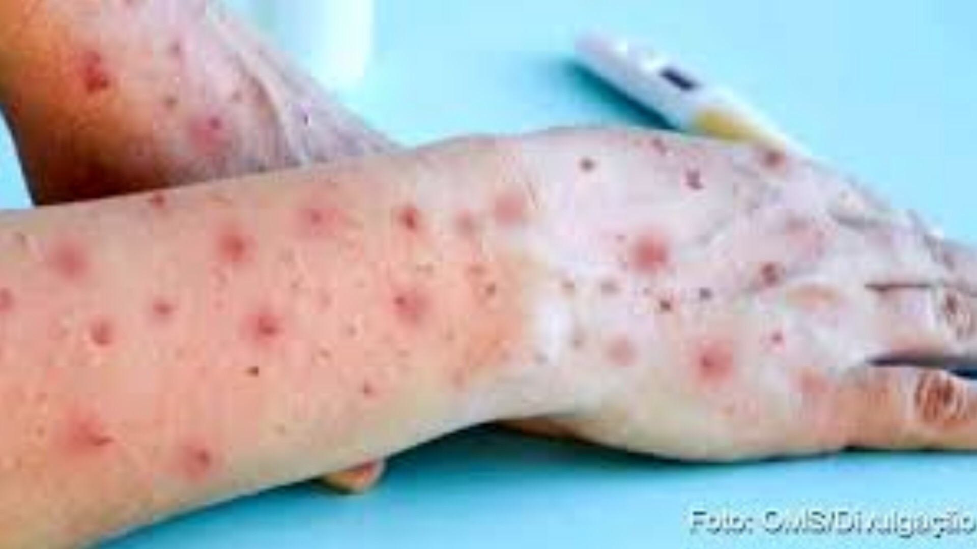 Pacientes com suspeita de mpox testam negativo para a doença em Governador Valadares